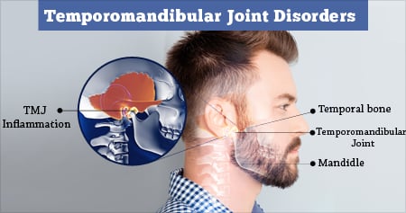 Temporomandibular Joint (TMJ) Disorders