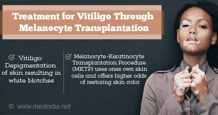 New Treatment for Vitiligo