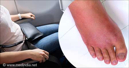 Why Does Foot Swelling Occur While Flying?
