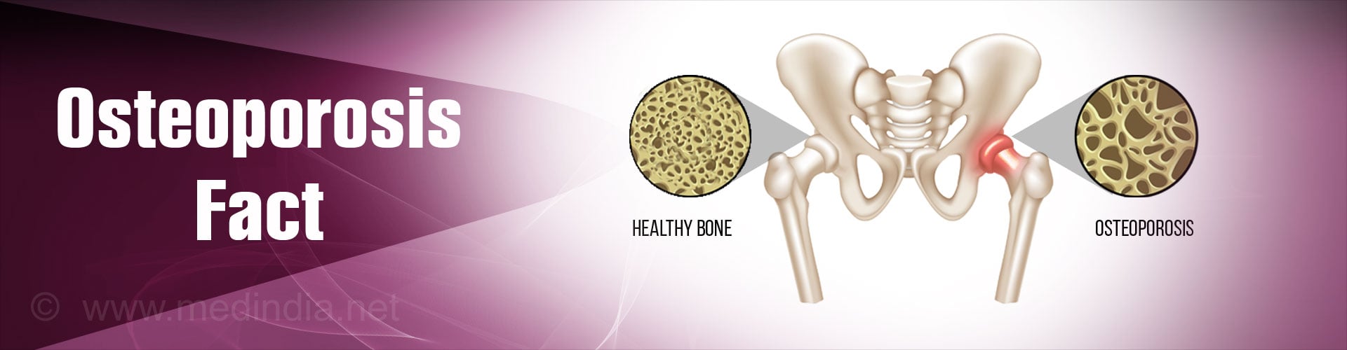 Top 10 Facts on Osteoporosis