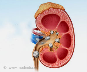 Home Remedies for Kidney Stones