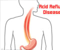 Acid Reflux Disease / GERD - Home Remedies Acid Reflux Disease / GERD - Home Remedies