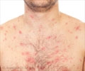 Home Remedies For Chickenpox
