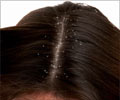 Home Remedies for Dandruff