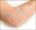 Home Remedy Tips to Treat Eczema 
