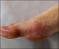 Gout Home Remedy