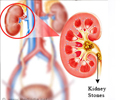 Home Remedies for Kidney Stones