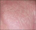 Measles Treatment - Home Remedy