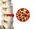 Home Remedies for Osteoporosis