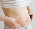 Home Remedies for Stretch Marks 