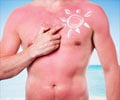 Top 10 Home Remedies for Sunburns