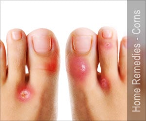 Effective Home Remedies for Corns on Feet: Causes, Treatment & Prevention