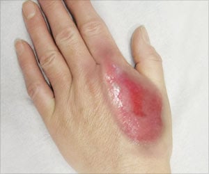 Do’s and Don’ts of Natural Treatments for Burns