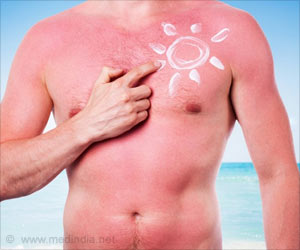 Top 10 Home Remedies for Sunburns