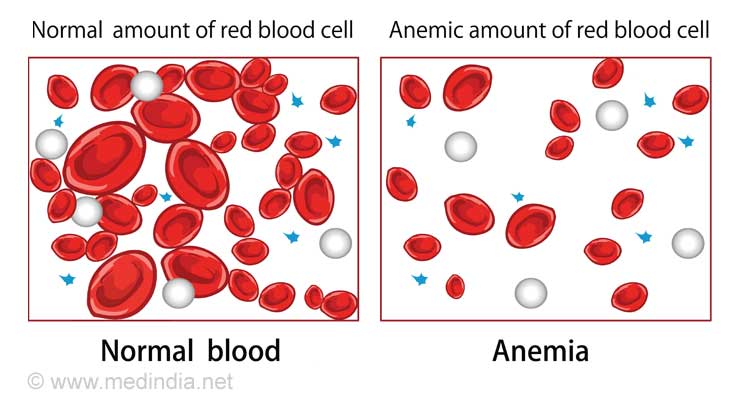 Anemia is One of the Causes of Vertigo Anemia is One of the Causes of Vertigo