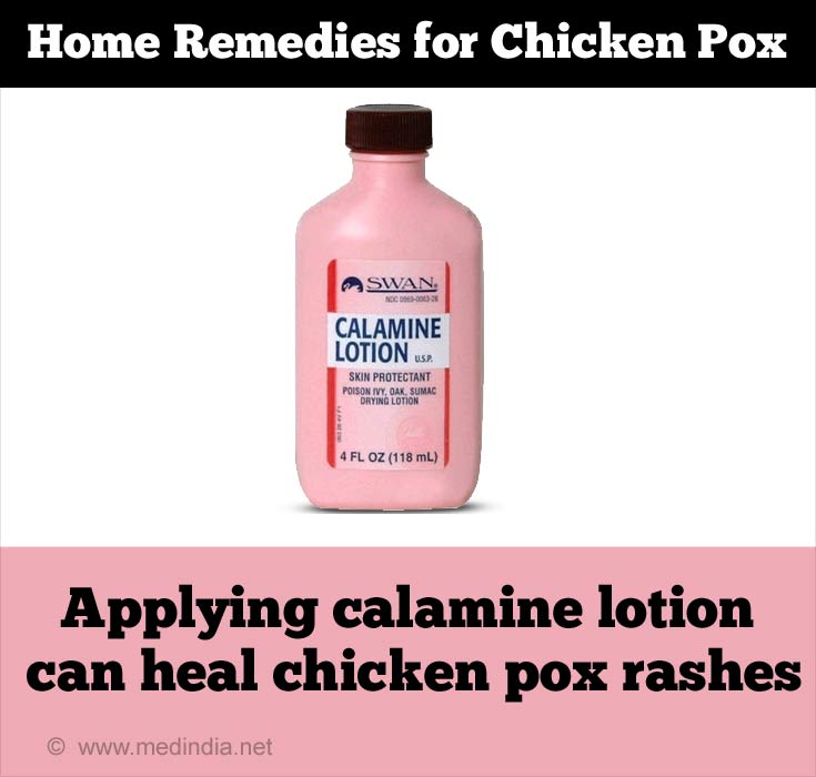 Calamine Lotion for Chicken Pox Rashes