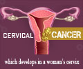 Infographics on Cervical Cancer