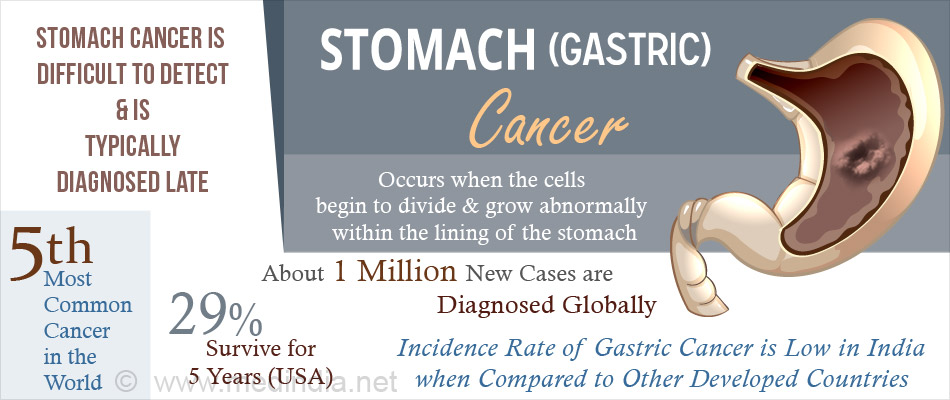 Facts About Stomach Cancer Facts About Stomach Cancer