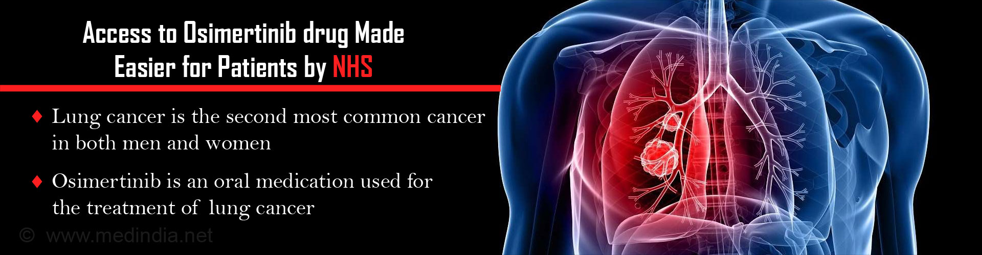 Osimertinib for Lung Cancer Available Through NHS