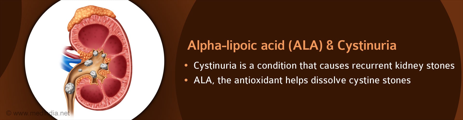 Alpha-lipoic Acid Prevents Kidney Stones in Rare Genetic Disease