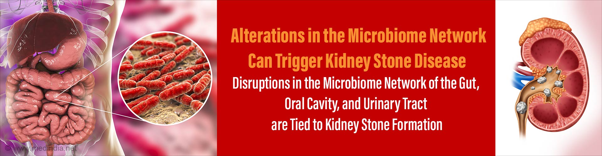 How Altered Microbiome Can Raise Kidney Stone Formation?