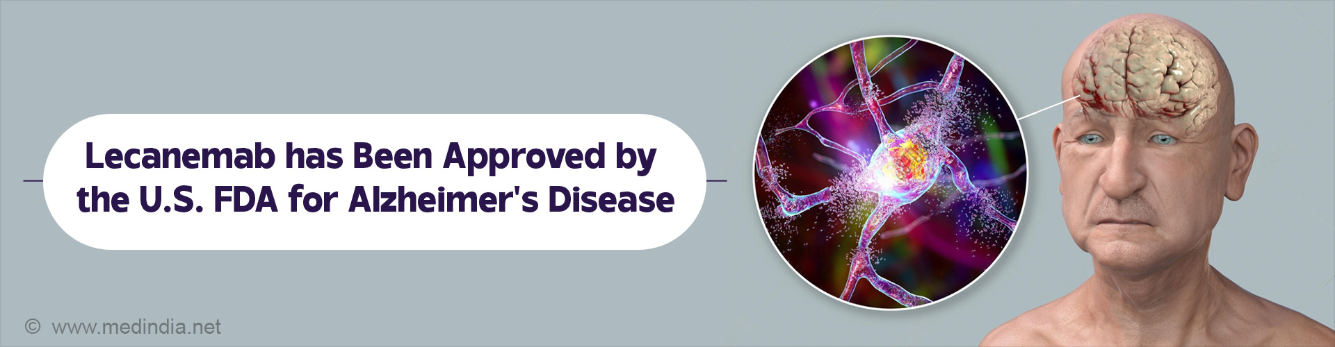 Alzheimerâ€™s Drug that Slows Down Cognitive Decline Approved by FDA