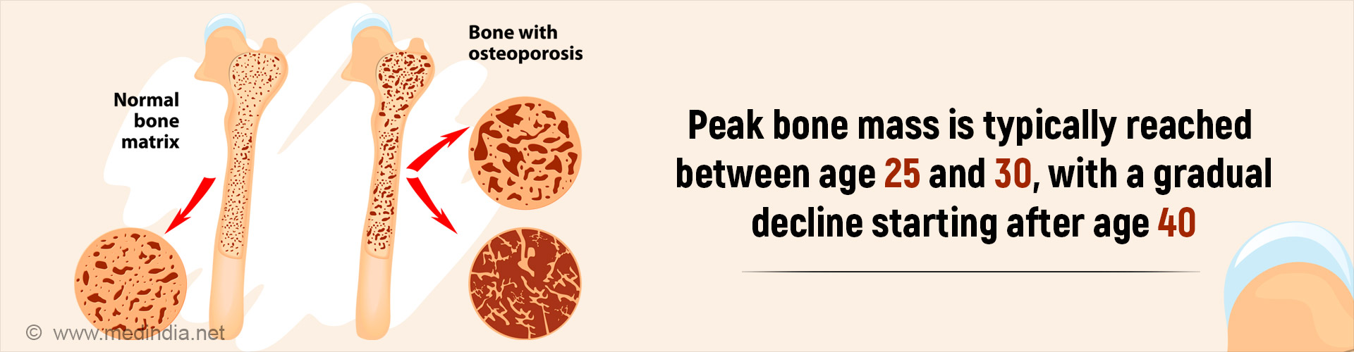 Could Poor Sleep Be Leading to Bone Loss?