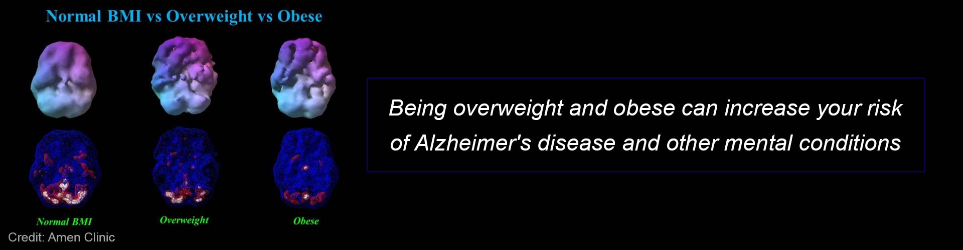 Childhood Obesity: A Sign for Poor Heart Health