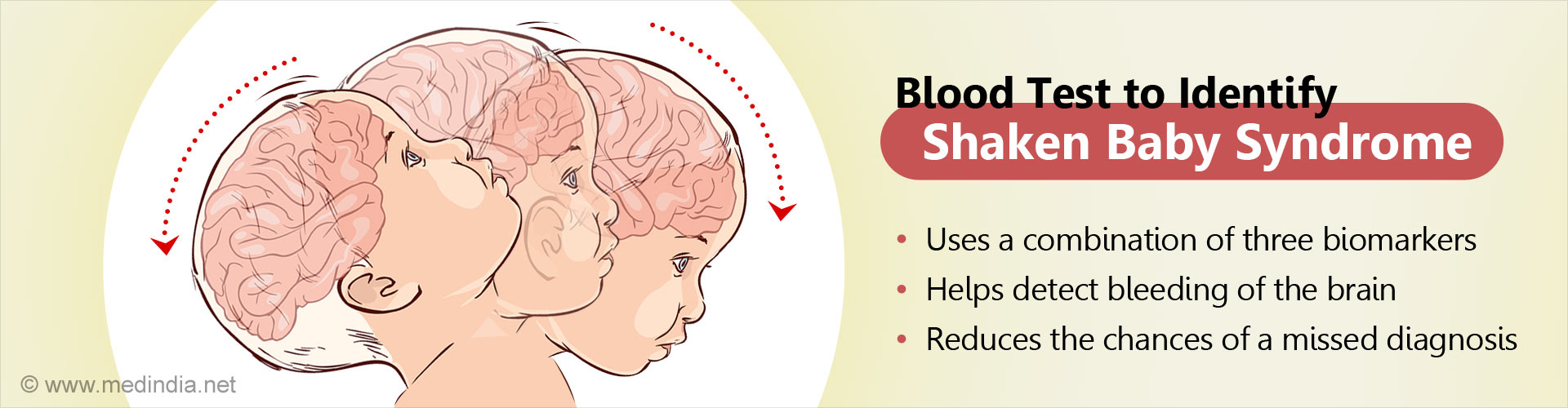 First Blood Test To Detect Shaken Baby Syndrome