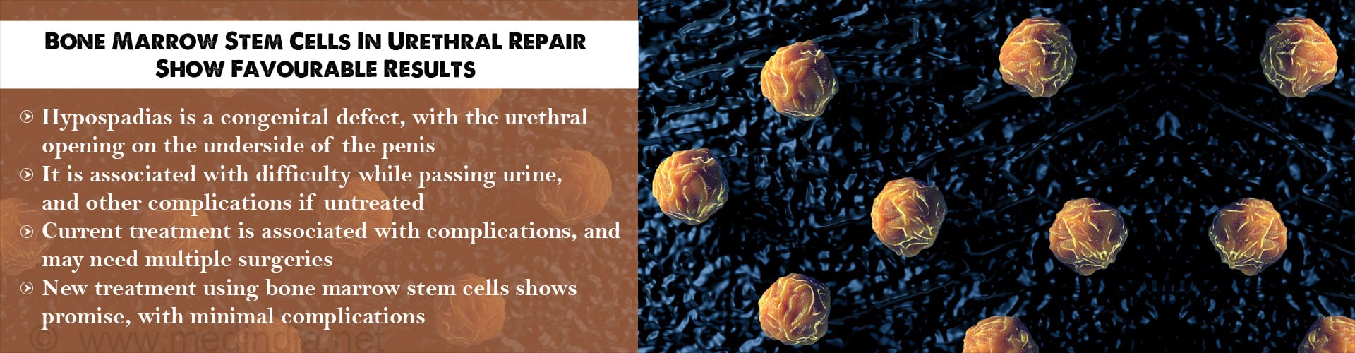 Urethral Repair Using Bone Marrow Stem Cells Shows Encouraging Results