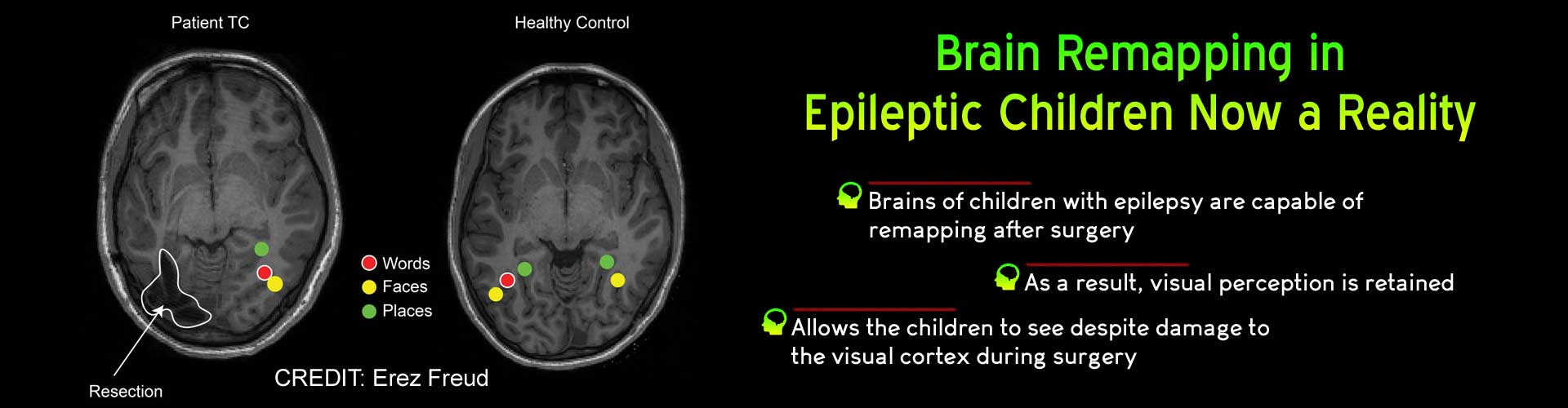Children With Epilepsy can Retain Visual Perception After Surgery: Here’s How Children With Epilepsy can Retain Visual Perception After Surgery: Here’s How
