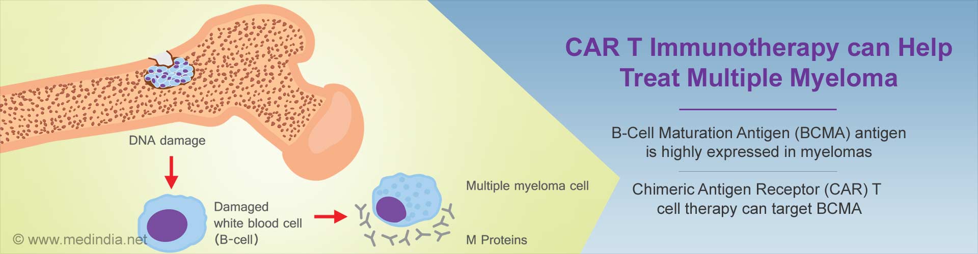 Car T Immunotherapy Shows Promise In Treating Multiple Myeloma