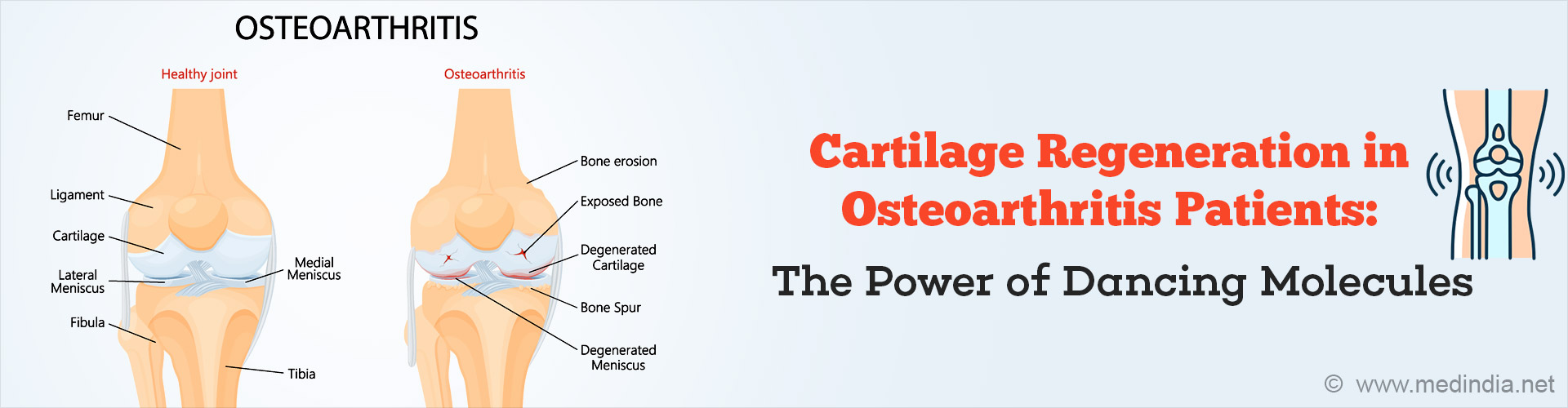 Dancing Molecules: Future of Osteoarthritis Cartilage Repair