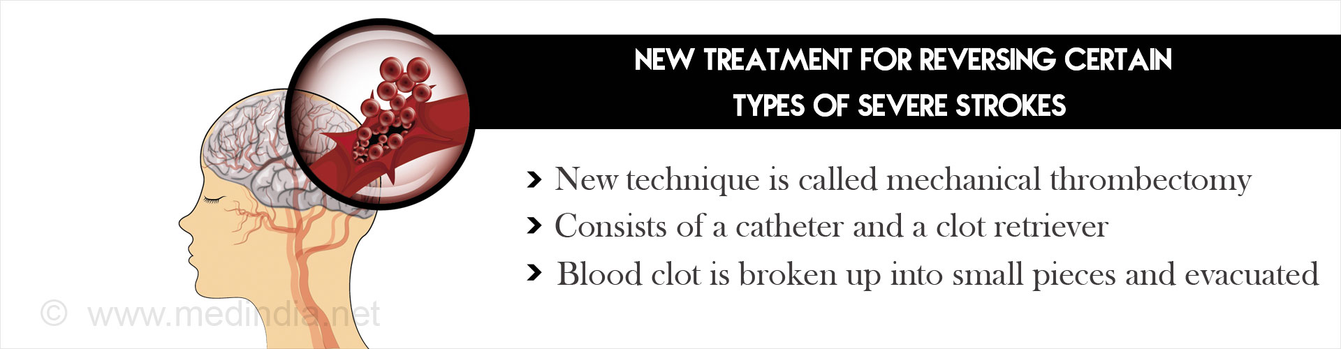 Mechanical Thrombectomy Treatment for Stroke Effective in Bringing Patients “Back to Life”