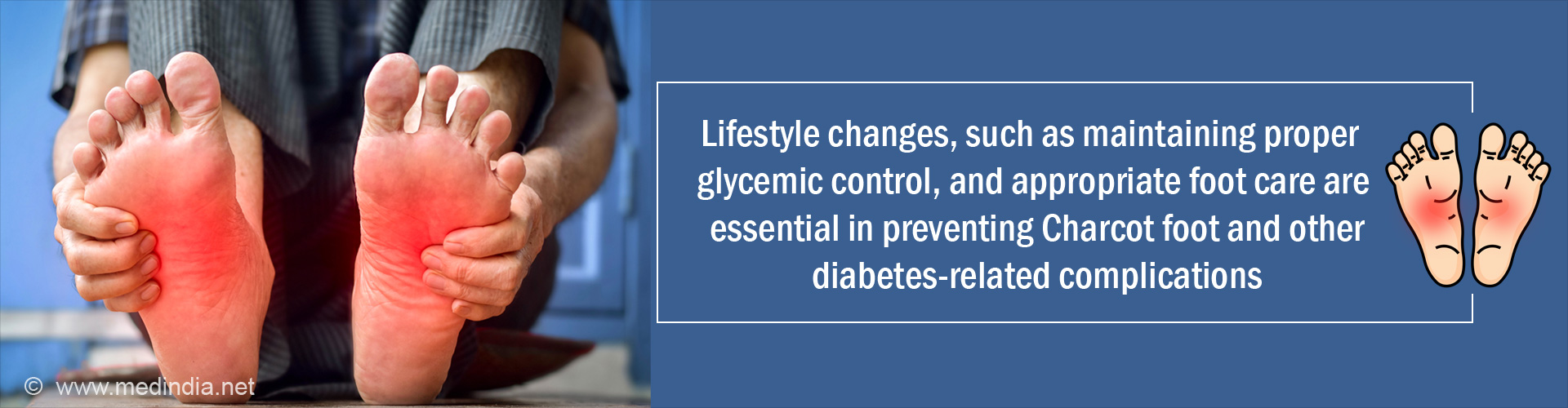 Diabetic Foot: A Commonly Mismanaged Complication