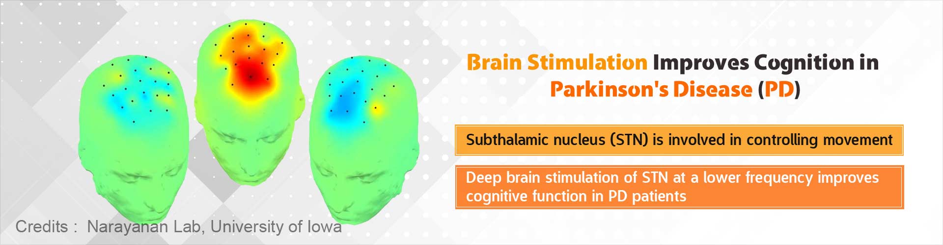 Cognitive Function Can be Improved In Parkinson's Disease Patients Cognitive Function Can be Improved In Parkinson's Disease Patients