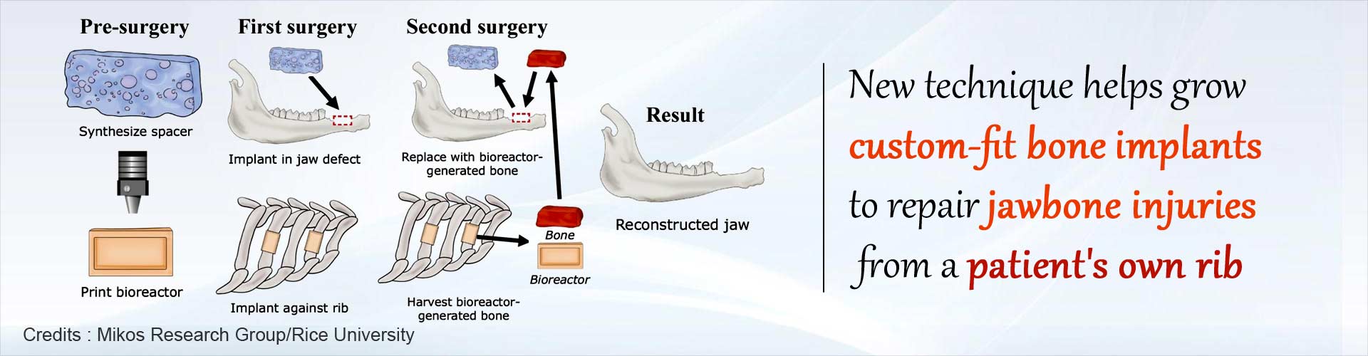 Your Own Rib can Help Reconstruct Your Jawbone: Here’s How