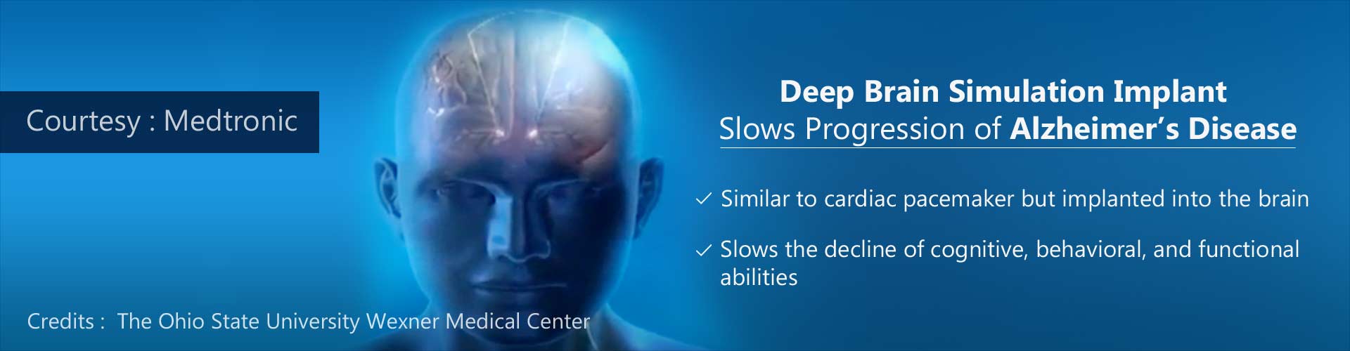 Brain Pacemaker Slows the Progression of Alzheimer's Disease