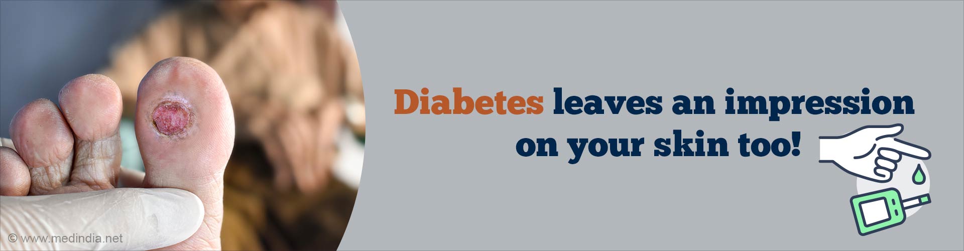 Skin Manifestations of Diabetes You Shouldn't Ignore