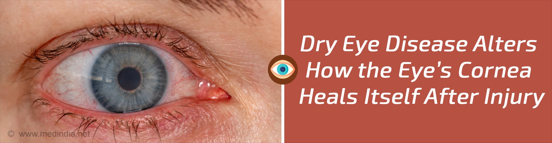 Dry Eye Disease can Alter Healing of the Cornea Post Injury