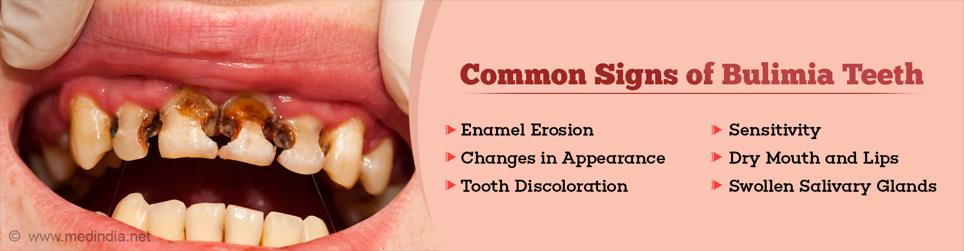 Bulimia Teeth: How Eating Disorders Affect Your Smile