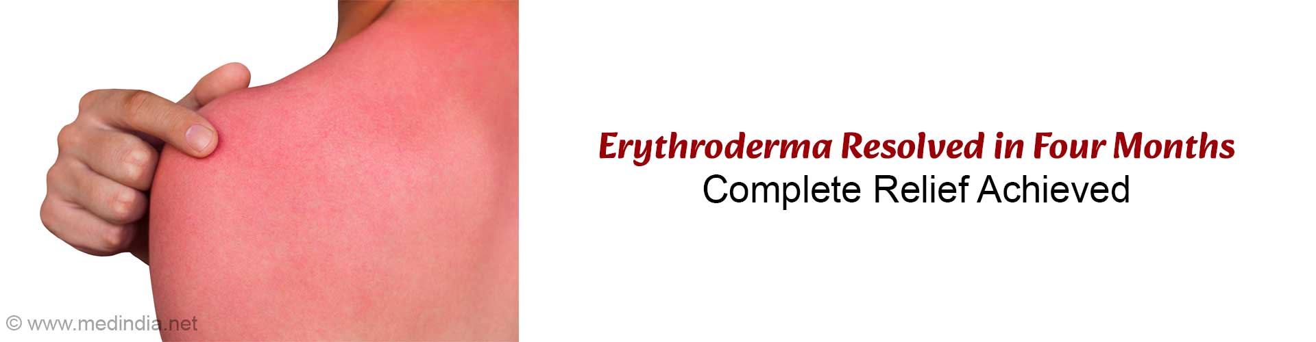 Erythroderma Treated Successfully With Targeted Immune Therapy