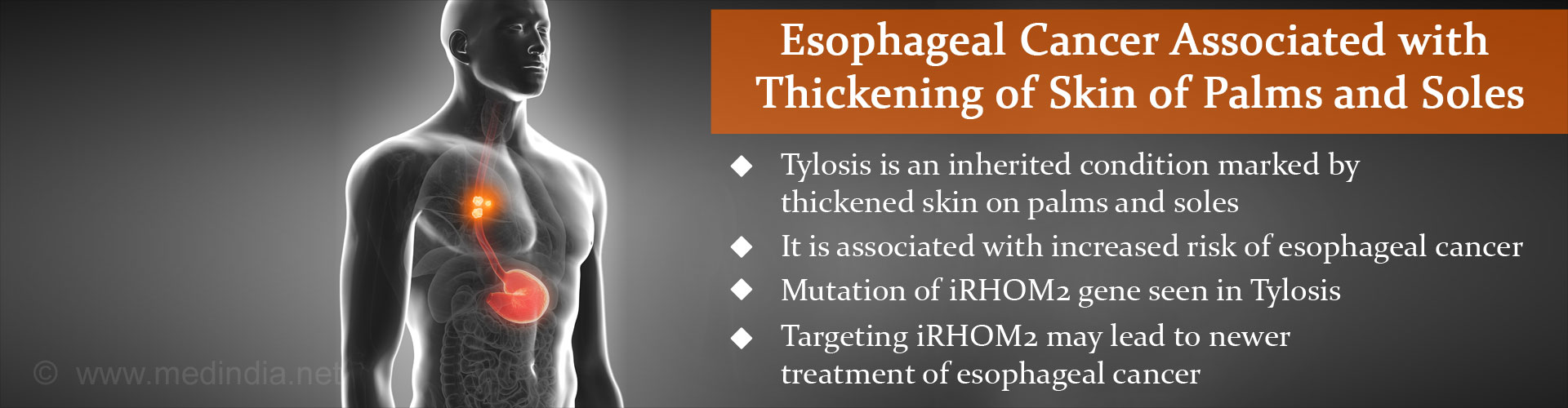 Thick Skin Over Palms and Soles Linked to Esophageal Cancer Thick Skin Over Palms and Soles Linked to Esophageal Cancer