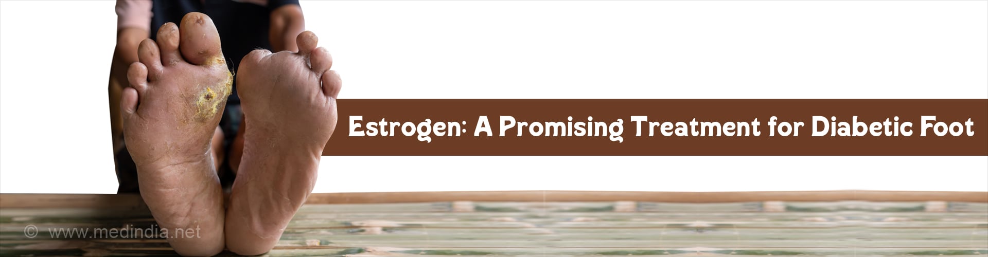 Estrogen: A Promising New Role in Treating Chronic Diabetic Foot