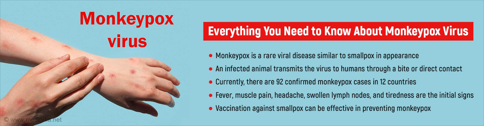 Monkeypox Outbreak: What It Is, How Does It Spread & the Prevention