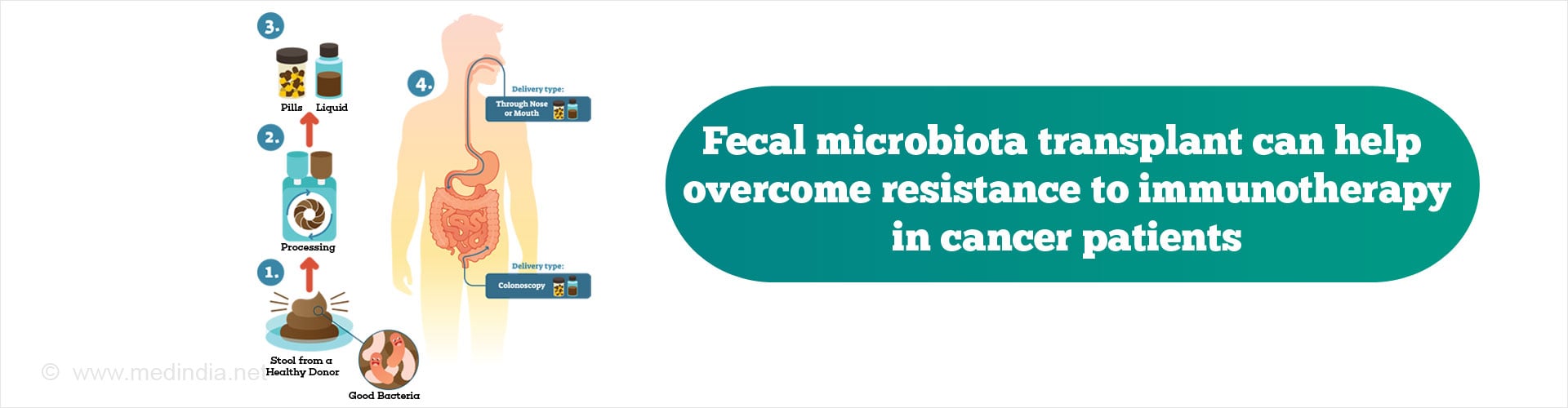 Fecal Microbiota Transplant Helps Treat Cancer Resistant to Immunotherapy