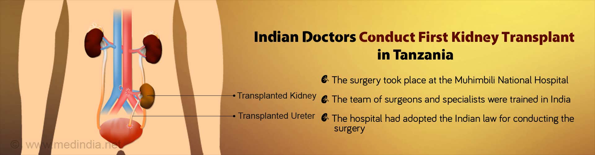 First Kidney Transplant in Tanzania By Indian Doctors