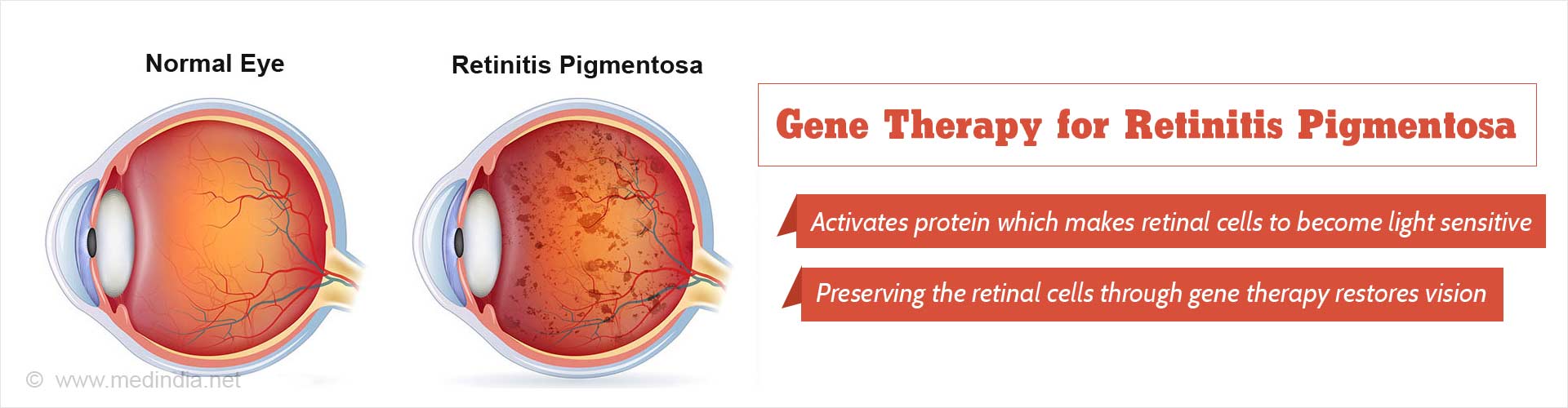 Blindness Due To Degeneration of Retinal Cells Can Be Reversed