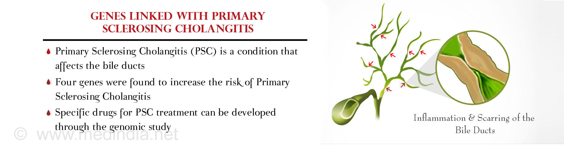 Four New Genes May Increase Risk of Primary Sclerosing Cholangitis Four New Genes May Increase Risk of Primary Sclerosing Cholangitis