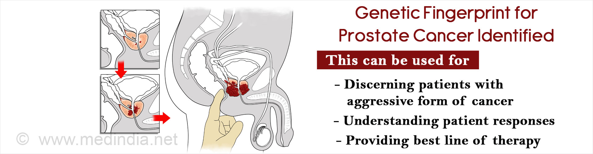 Genetic Fingerprint to Identify Prostate Cancer Prognosis